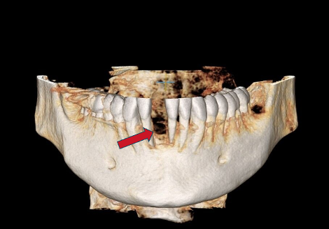 Bone Grafting Case 1 Before Alternate