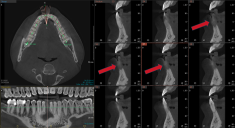 Bone Grafting Case 1 Before