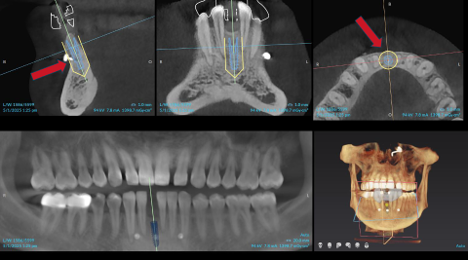 Bone Grafting Case 1 After