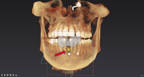 Bone Grafting Case 1 After Alternate