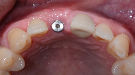 Bone Grafting Case 2 After