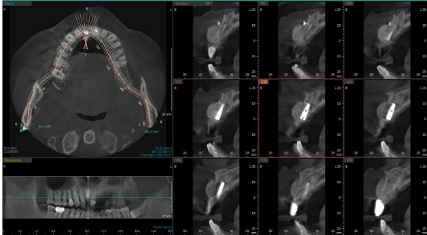 Bone Grafting Case 2 After CBCT