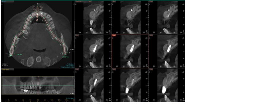 Bone grafting Case 2 after CBCT