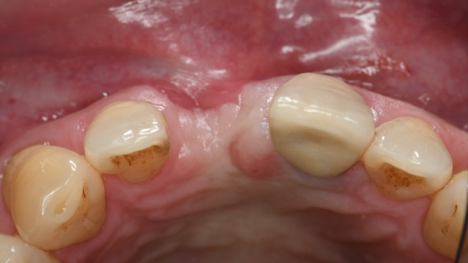 Bone Grafting Case 2 Before