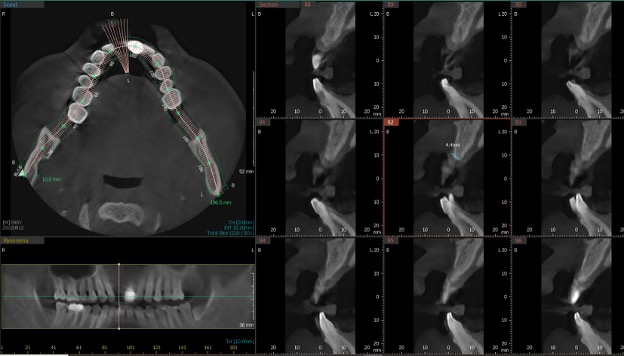 Bone Grafting Case 2 Before CBCT