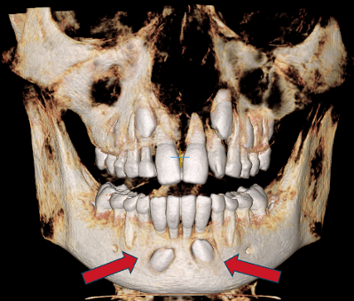 Canine Exposure CBCT Before