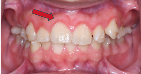 Crown Lengthening After