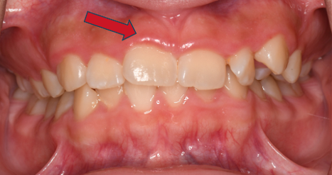 Crown Lengthening Before