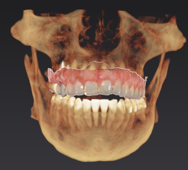 3D X-ray planning image