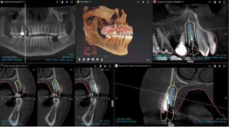 CBCT and implant planning