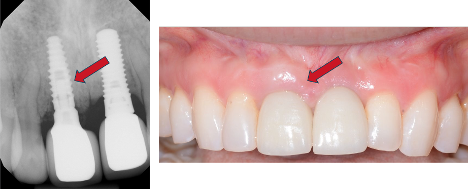 Implant case overview