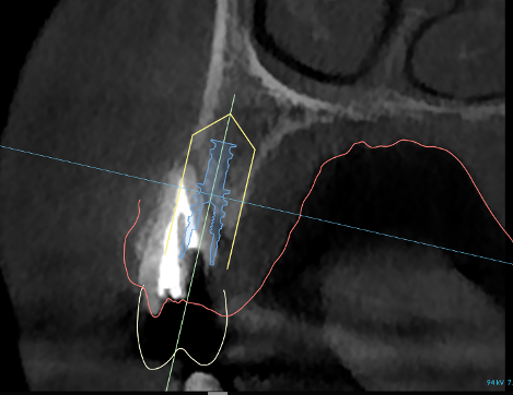 Implant planning software view