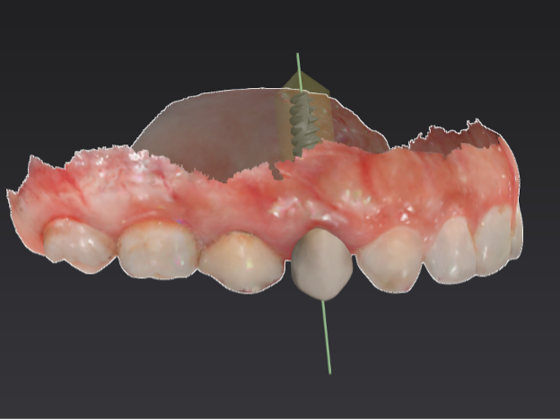 Implant planning additional view