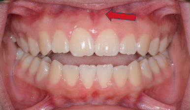 Frenectomy After