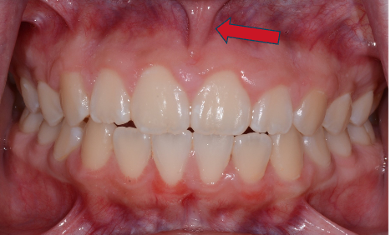 Frenectomy Before