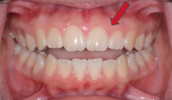 Gingivectomy After