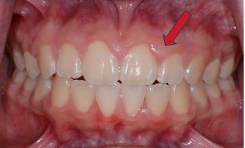 Gingivectomy Before