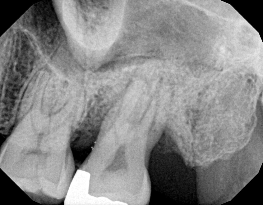 LANAP X Rays Case 1 Before