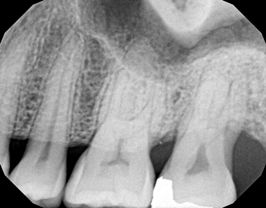 LANAP X Rays Case 1 After 6 Months