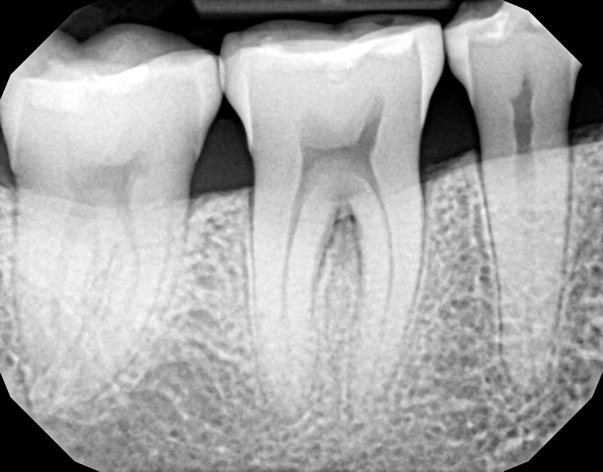LANAP X Rays Case 2 After 14 Months