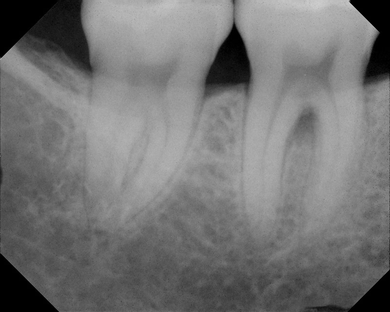 LANAP X Rays Case 2 After 6 Months