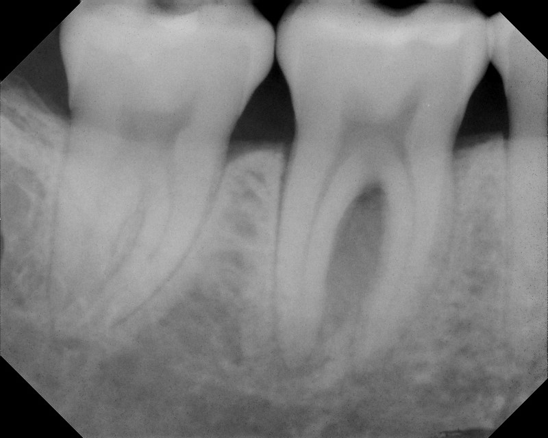 LANAP X Rays Case 2 Before