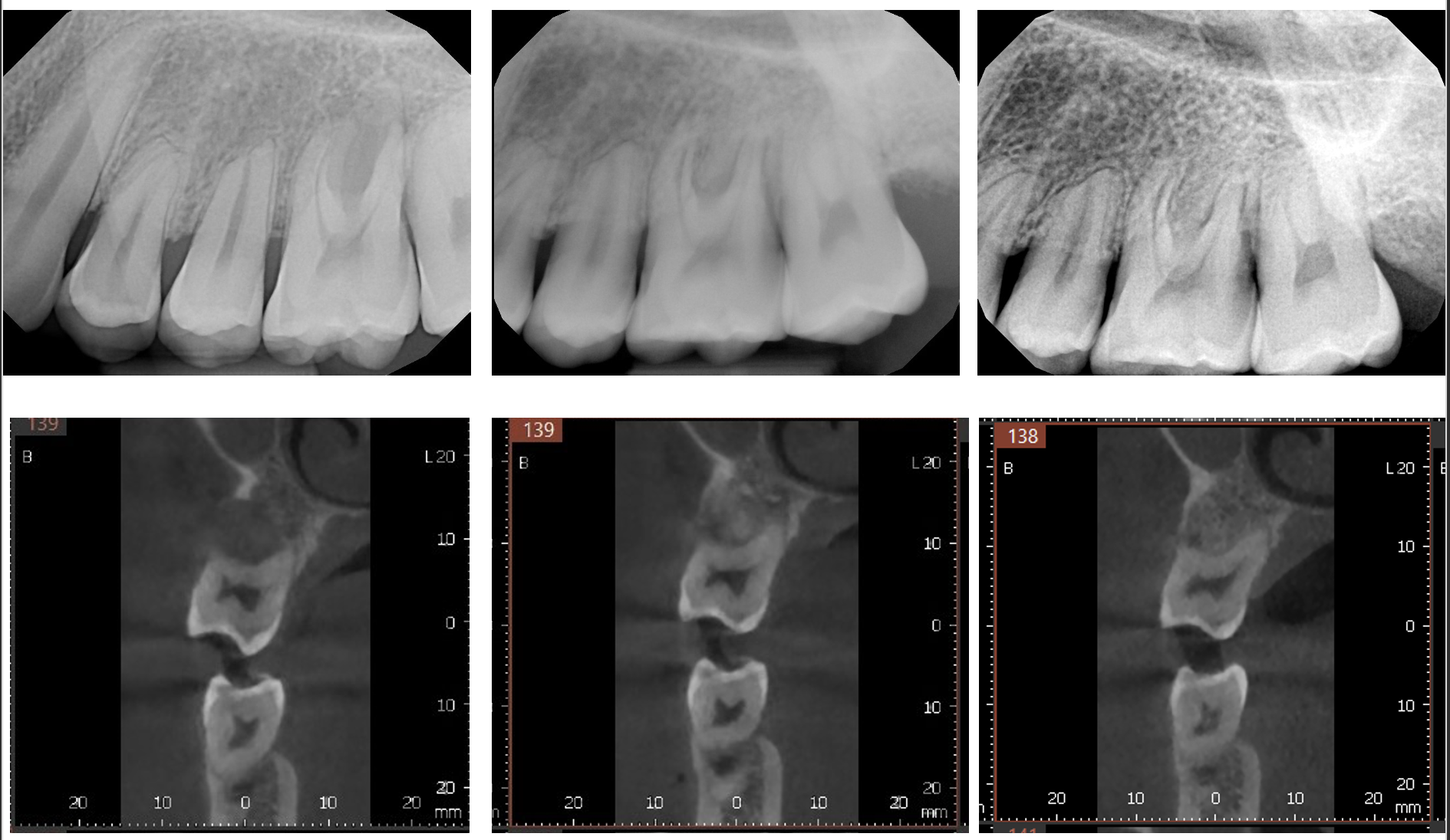 LANAP X Rays Case 3 Timeline