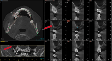 Sinus Grafting Before